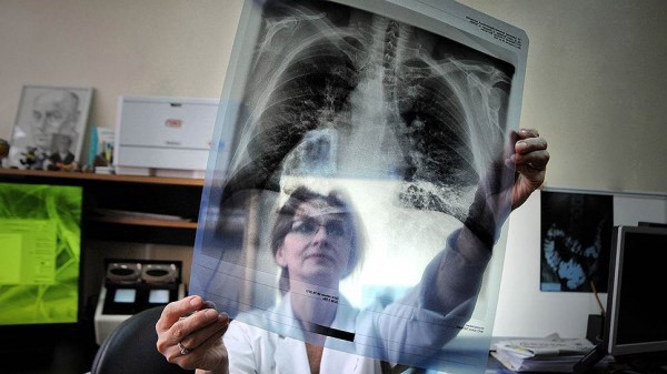 Обеспечение лечения и профилактических мероприятий каждого больного туберкулезом в ВКО обходится бюджету в 270 тысяч тенге в год.